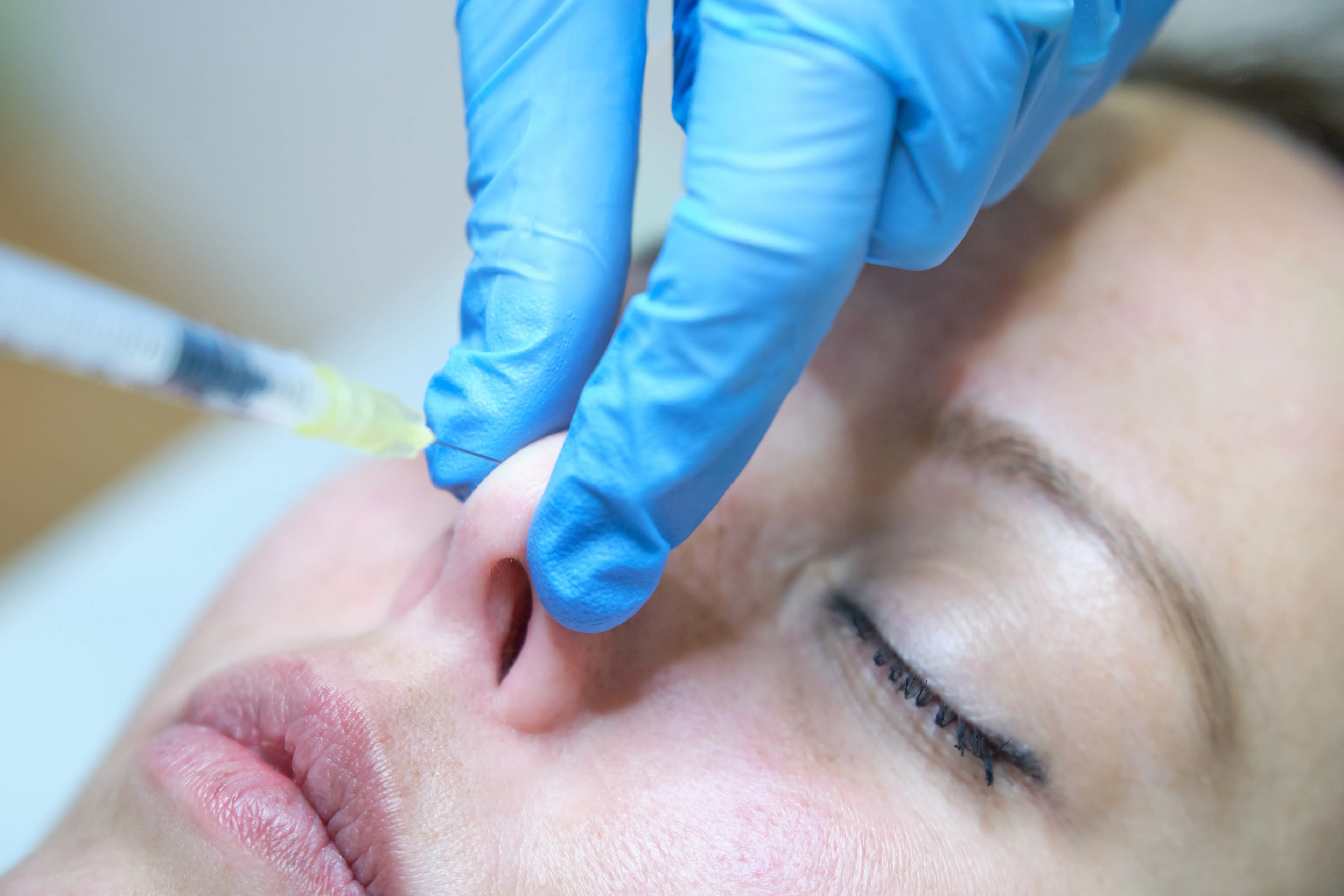 Nasenspitze korrigieren lassen in Köln - Präzise & minimalinvasive Techniken